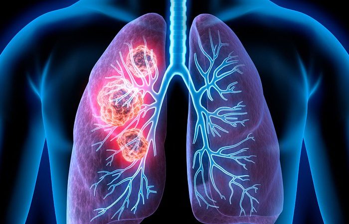 World Lung Cancer Day; അവഗണിക്കരുത് ഈ ലക്ഷണങ്ങളെ