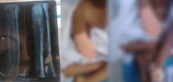 9 വയസുകാരിയുടെ പ്ലാസ്റ്ററിട്ട കൈ മുറിച്ചുമാറ്റേണ്ടിവന്ന സംഭവം<br>ആരോഗ്യമന്ത്രിയുടെ ഓഫീസില്‍ നിന്ന് സാഹചര്യങ്ങള്‍ വിലയിരുത്തി അന്വേഷിക്കാം എന്ന മാത്രം പറഞ്ഞു